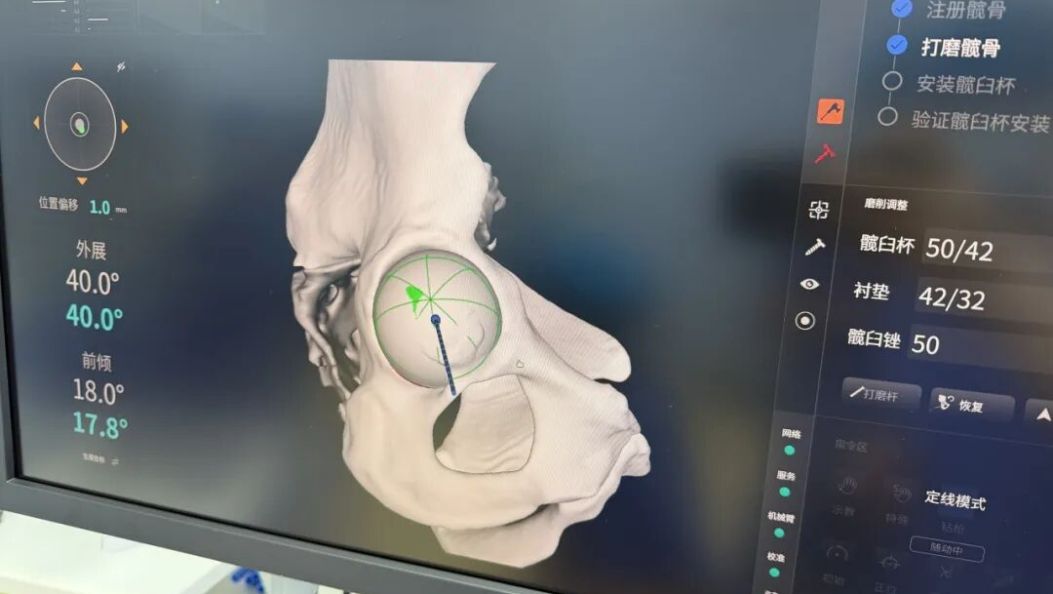 手术机器人上岗！已在大理完成20余台手术……